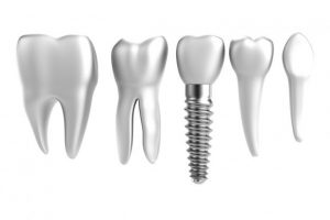 Schaumburg Dental Implants