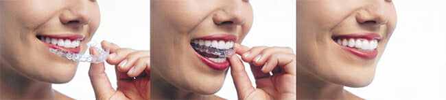 Invisalign Dentists Near You